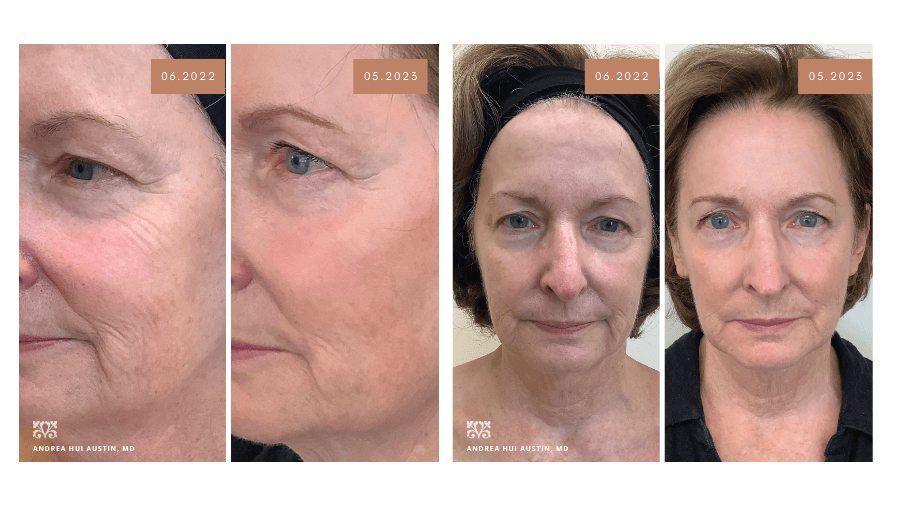 Patient Results from Sculptra